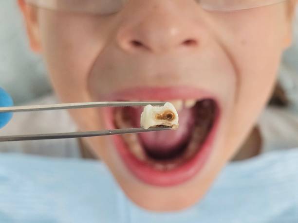 Best Emergency Tooth Extraction in Steep Falls, ME
